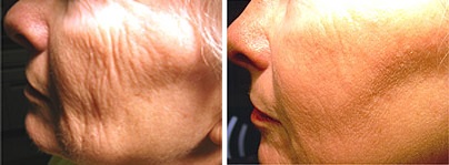 Before (left) and after (right) fractional skin resurfacing in Albuquerque, NM.