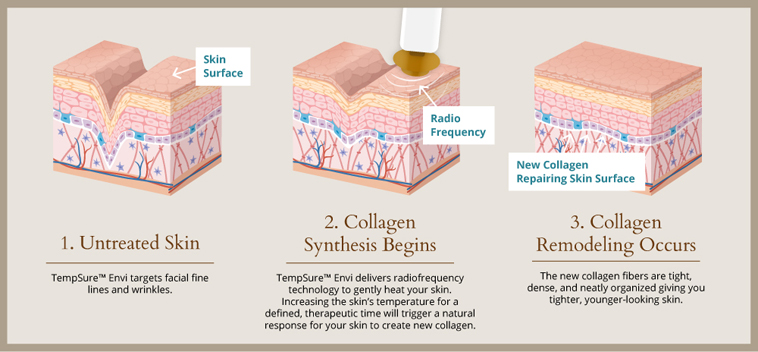 Learn how TempSure™ at Albuquerque's Western Dermatology Consultants employs radiofrequency to create tighter, radiant skin.
