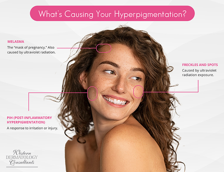 Learn what causes hyperpigmentation from Albuquerque’s Western Dermatology Consultants.
