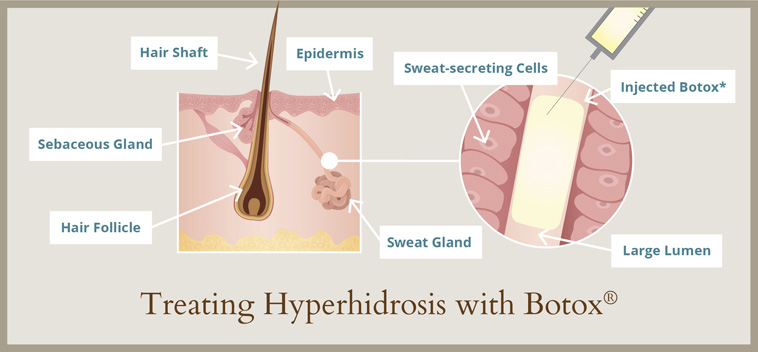 Treatments to curb hyperhidrosis at Albuquerque's Western Dermatology Consultants involve BOTOX® injected with precision.