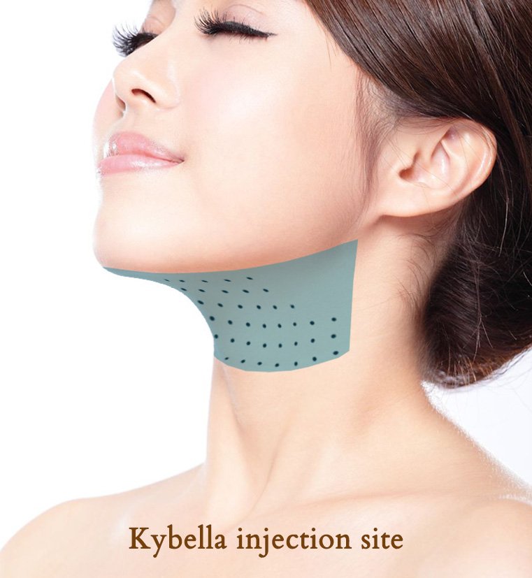 Kybella injections to the submental (under the chin) area