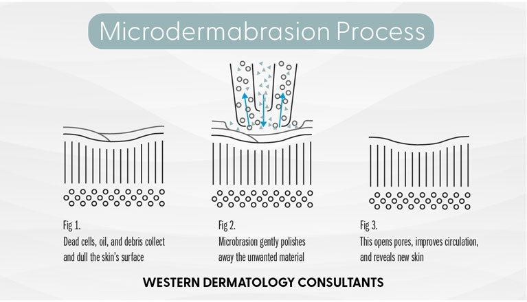 See how microdermabrasion at Albuquerque's Western Dermatology Consultants removes dead skin, oils, and more materials from the surface.